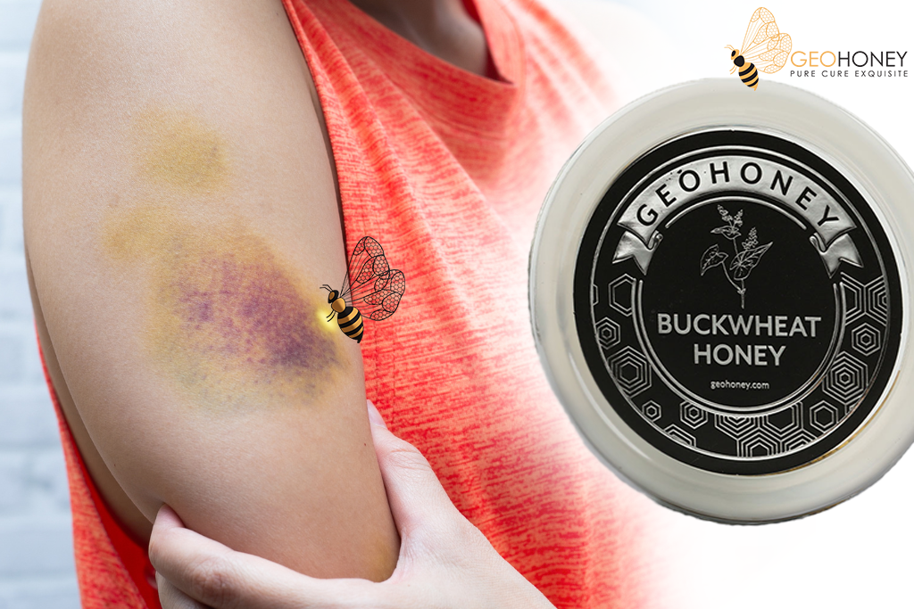 Raw Honey – A Natural Home Remedy For Blood Bruises
